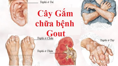 cay_gam_chua_benh_gut